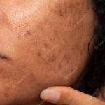 Mengatasi Bekas Jerawat PIH dengan Produk Skincare