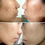 Penjelasan Ingredients Emina Ms.Pimple Moisturizer Gel