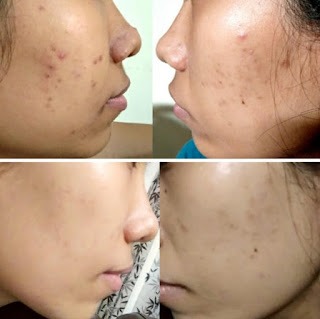 Penjelasan Ingredients Emina Ms.Pimple Moisturizer Gel