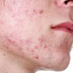 Rekomendasi Skincare yang aman untuk kulit oily + Acne prone Skin