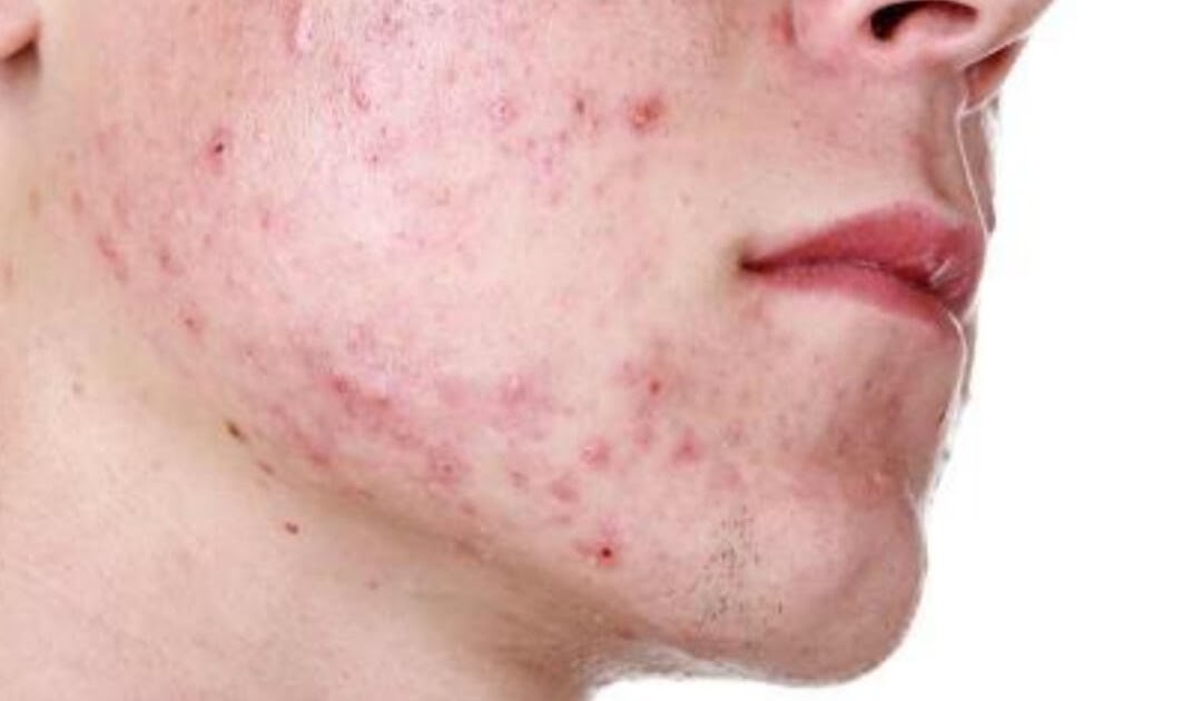 Rekomendasi Skincare yang aman untuk kulit oily + Acne prone Skin