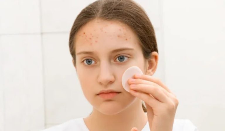 12 Tips Skincare Untuk kulit Remaja