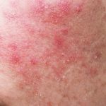 Ini dia! 10 Moisturizer untuk Kulit Sensitif dan Kering