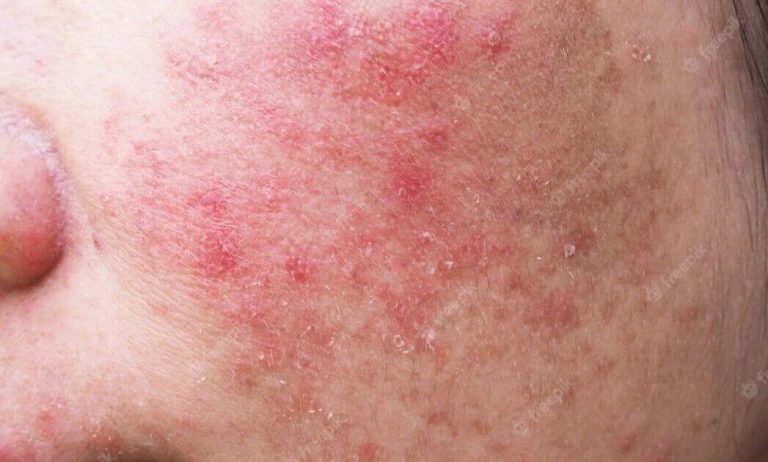 Ini dia! 10 Moisturizer untuk Kulit Sensitif dan Kering