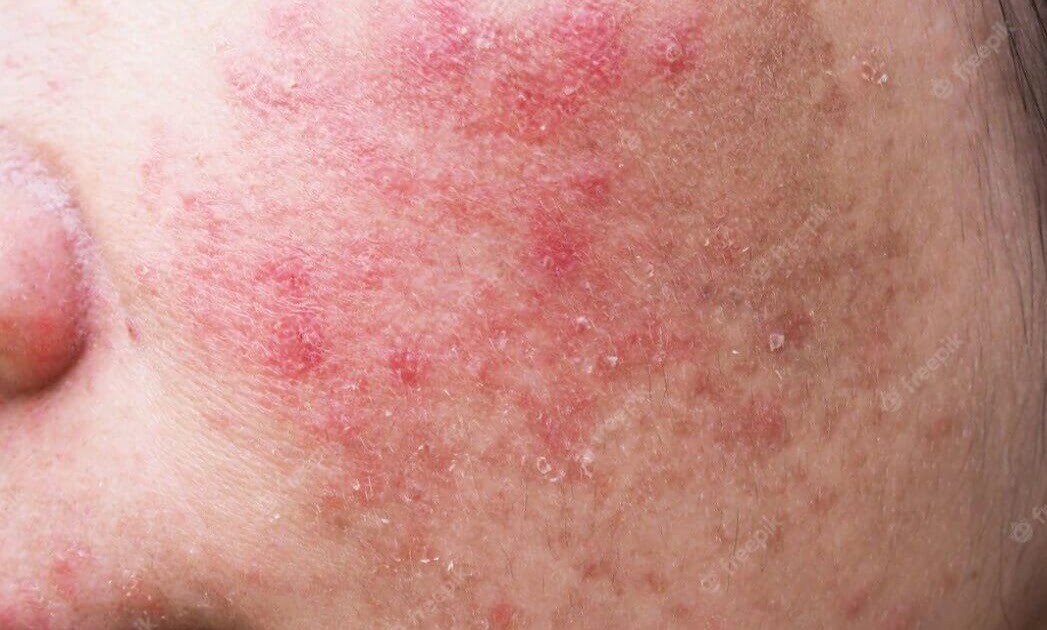 Ini dia! 10 Moisturizer untuk Kulit Sensitif dan Kering
