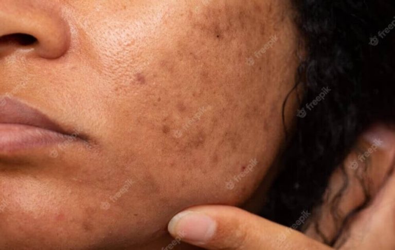 Mengatasi Bekas Jerawat PIH dengan Produk Skincare