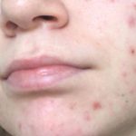 Mengatasi PIE dengan Produk Skincare: Rahasia Kulit Bebas Kemerahan