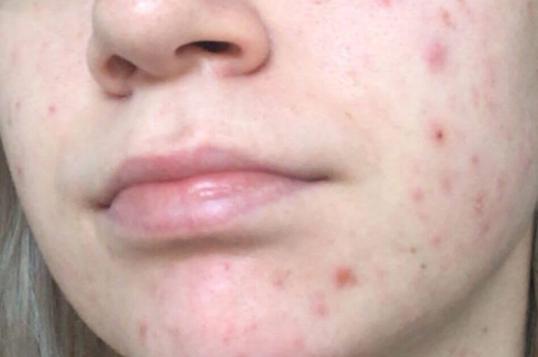 Mengatasi PIE dengan Produk Skincare: Rahasia Kulit Bebas Kemerahan
