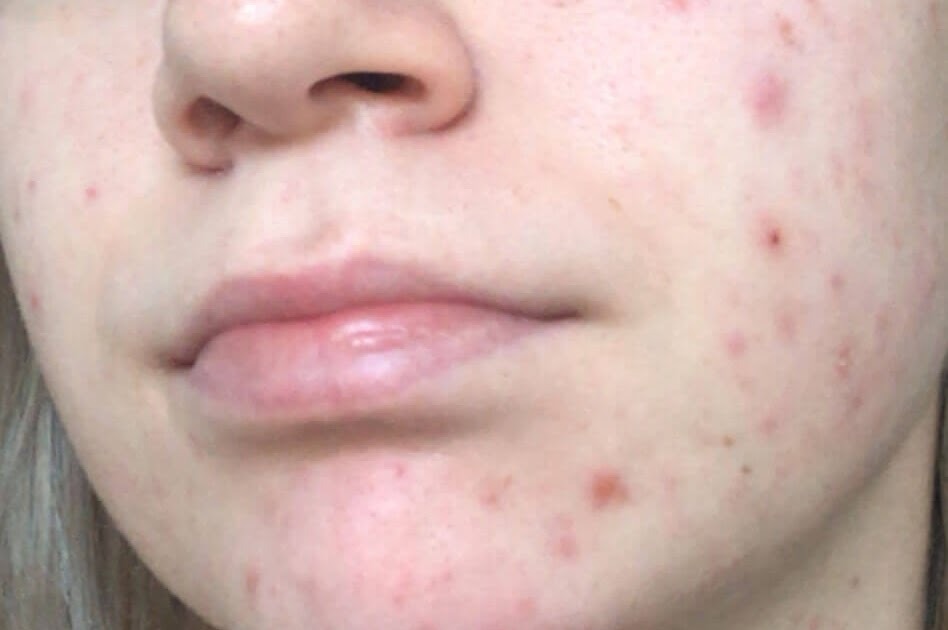 Mengatasi PIE dengan Produk Skincare: Rahasia Kulit Bebas Kemerahan