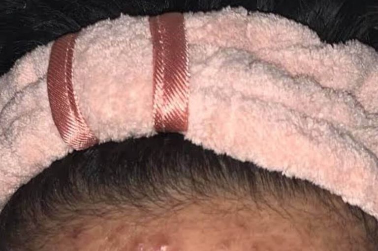 Panduan Lengkap Menggunakan Skincare untuk Menghilangkan Bekas Jerawat