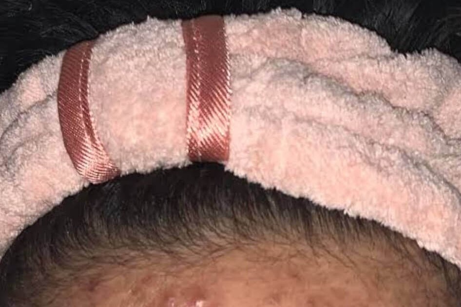 Panduan Lengkap Menggunakan Skincare untuk Menghilangkan Bekas Jerawat