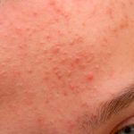 Rekomendasi Produk Skincare untuk Meredakan Bruntusan
