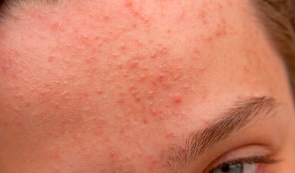Rekomendasi Produk Skincare untuk Meredakan Bruntusan