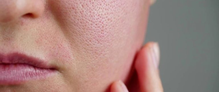 Rekomendasi Produk Skincare untuk Pori-pori Tampak Mengecil
