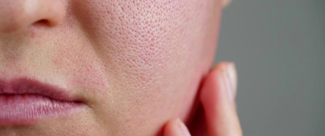 Rekomendasi Produk Skincare untuk Pori-pori Tampak Mengecil