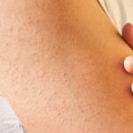 Photo by ultimagz.com - Cara Mengatasi Keratosis Pilaris dengan Lotion Urea yang Efektif
