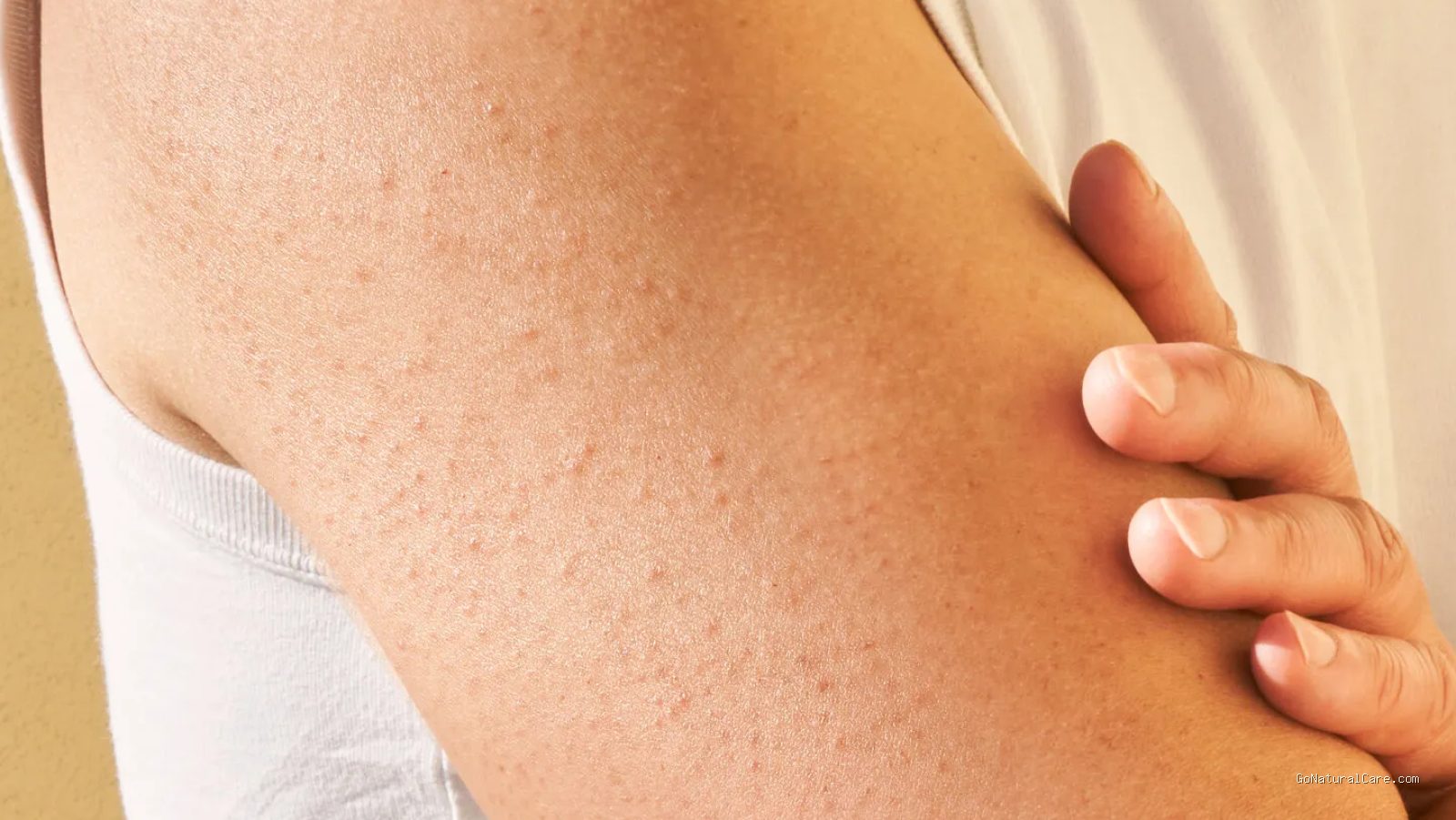 Photo by ultimagz.com - Cara Mengatasi Keratosis Pilaris dengan Lotion Urea yang Efektif