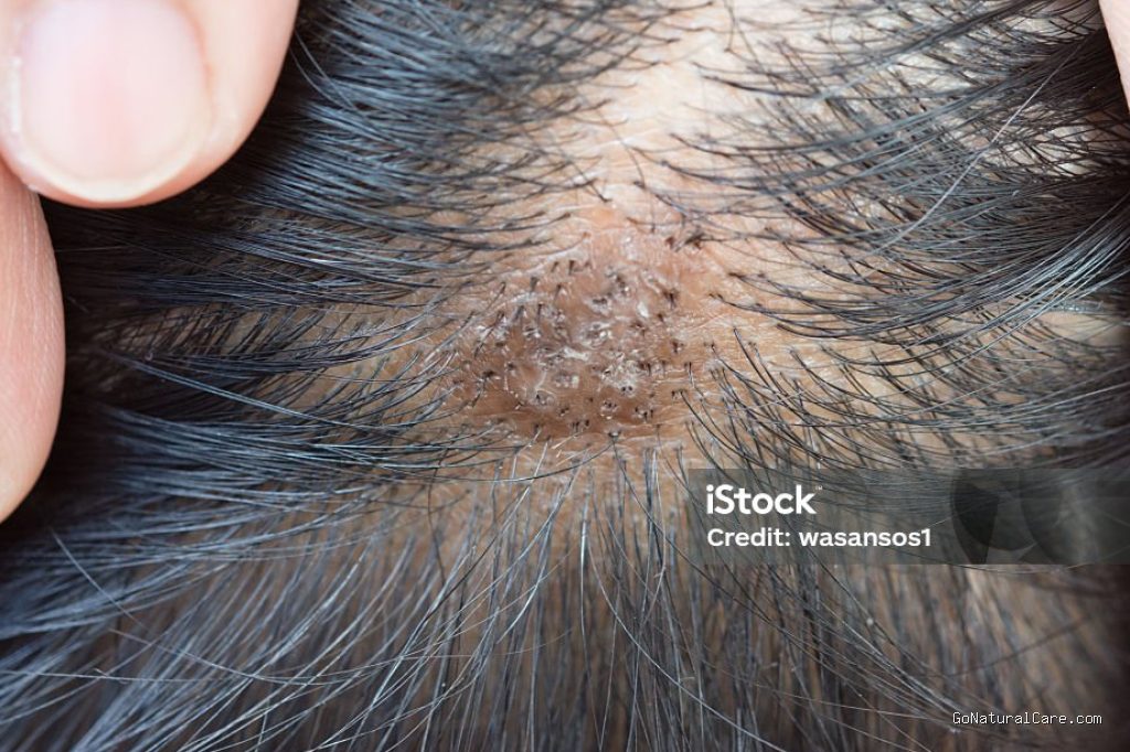 Photo by istockphoto.com - Ciri Kulit Kepala Butuh Scalp Detox Akibat Penumpukan Silikon Produk Pabrikan