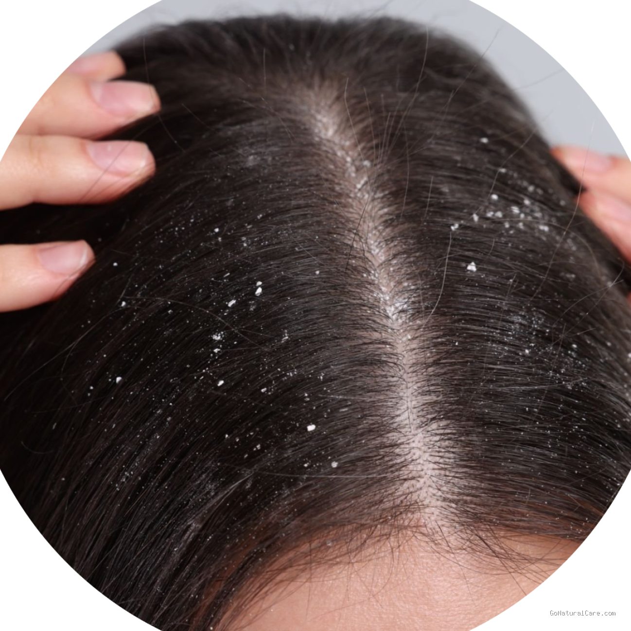 Ciri Kulit Kepala Butuh Scalp Detox Akibat Penumpukan Silikon Produk Pabrikan