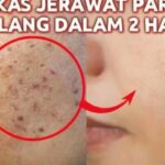 Photo by radarpekalongan.disway.id - Efektivitas Ekstrak Centella untuk Menghilangkan Noda PIE