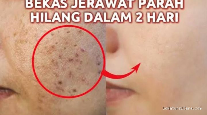Photo by radarpekalongan.disway.id - Efektivitas Ekstrak Centella untuk Menghilangkan Noda PIE
