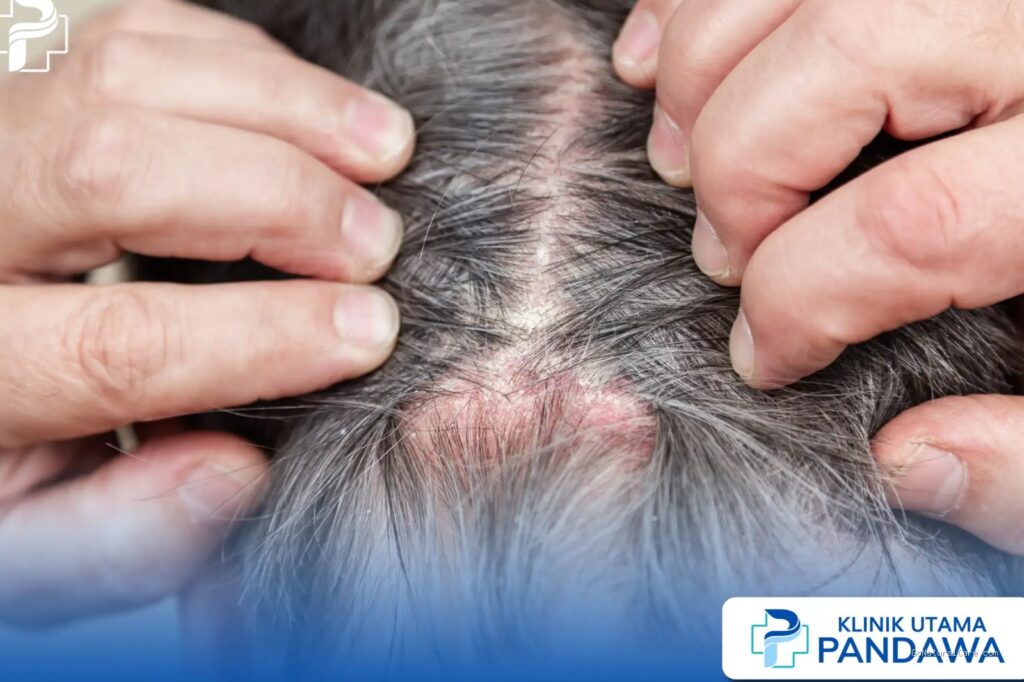 Photo by klinikpandawa.com - Ciri Kulit Kepala Alergi Minyak Nabati Beda dengan Penyesuaian Formula Alami
